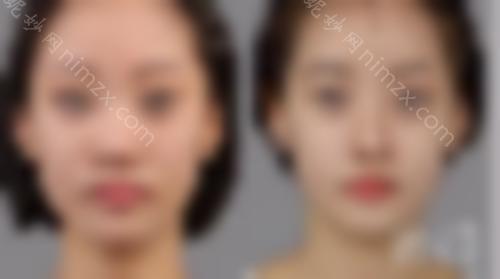 哇~隆鼻后这些鼻型很美！