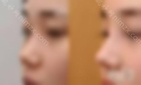 哇~隆鼻后这些鼻型很美！