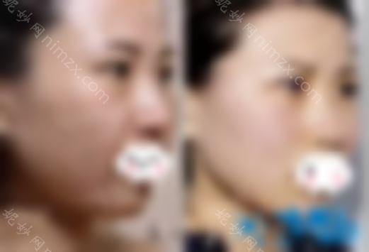 武汉天申整形医院面部埋线升级值不值 她的面值