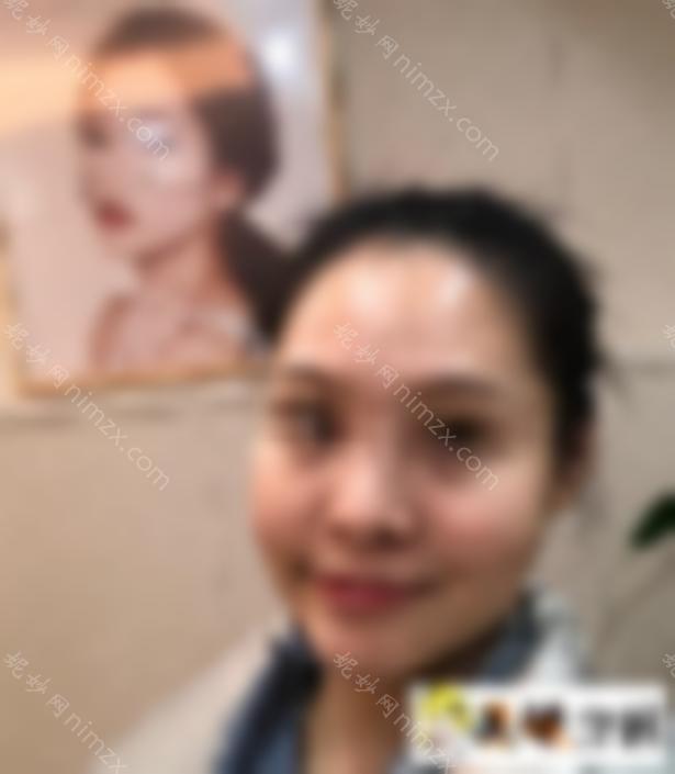 大脸怎么瘦脸？一定要做手术吗？