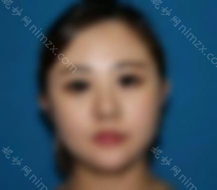 注射胶原蛋白填充唇部效果好吗？丰唇前后真实图例