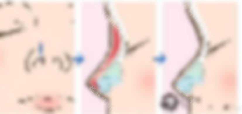 自体软骨隆鼻安全吗？如何提高手术的安全性和成功率？