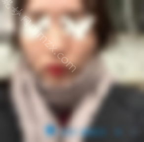 【日志】看看我在上海九院找韦敏花5.5万元磨颧骨的效果。