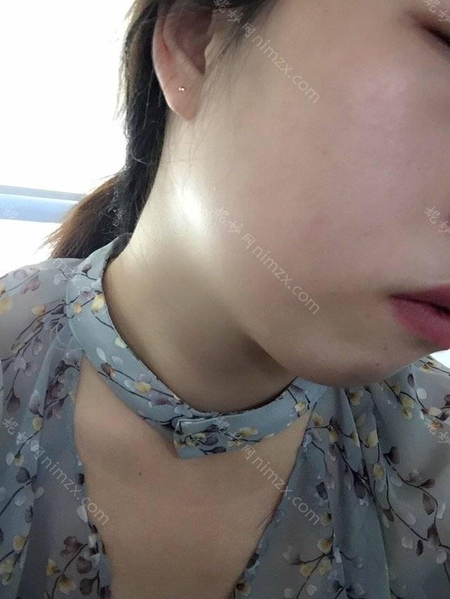 贵阳颜之美面部吸脂做的好吗？有没有整形案例分享