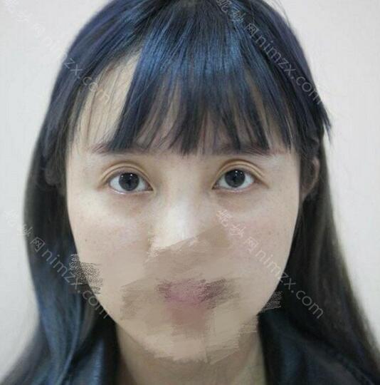 上海九院董佳生双眼皮修复好不好?口碑好吗?