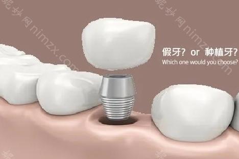 上海种牙去公立医院好还是私立医院好?广大牙友给您三个建议!